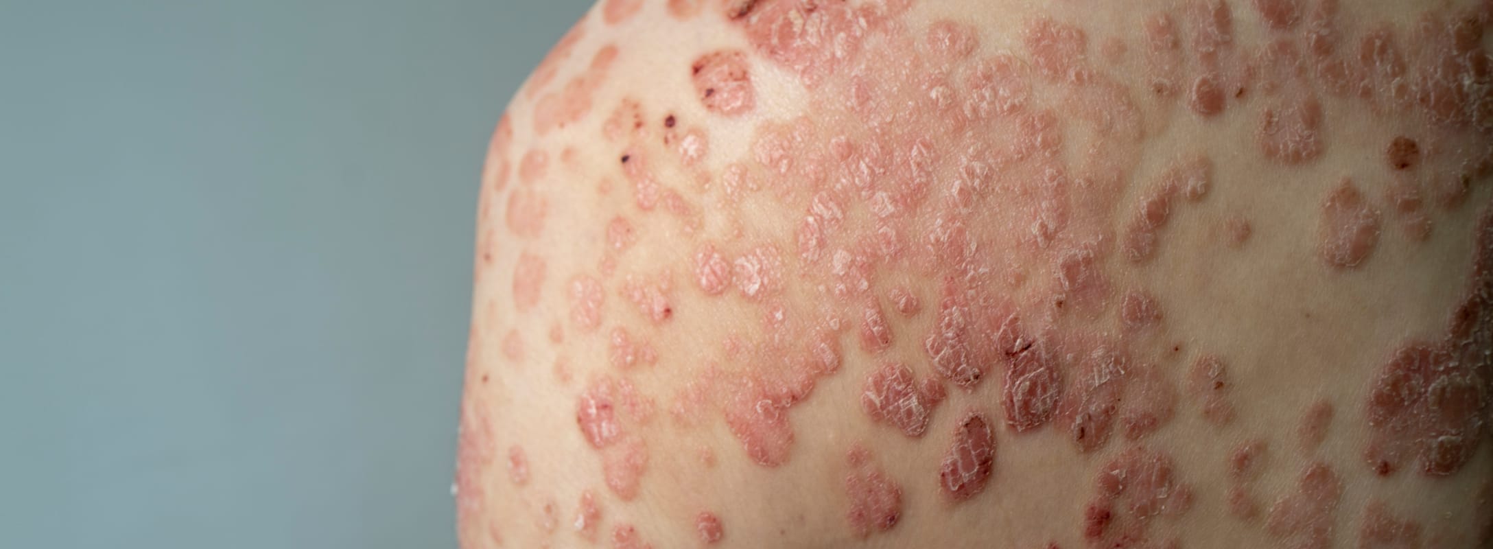 Autoimmune conditions